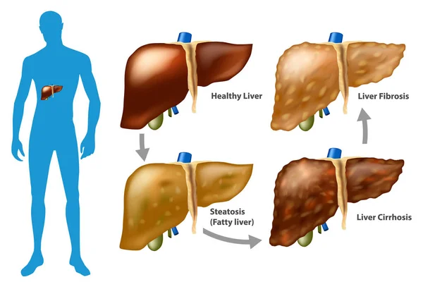 Karaciğer hasarı aşamaları. Karaciğer hastalığının ilerlemesi. (Yağlanma, fibrozis, siroz)