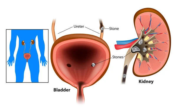 Nephrolithiasis Kidney Stones Disease Urolithiasis Renal Calculus Stones Blocking Urinary — Stock Vector