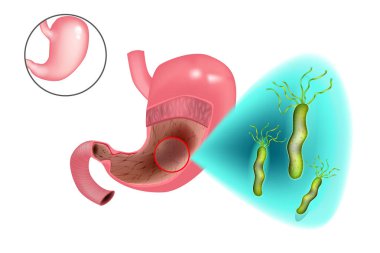 Helicobacter pylori bacteria or Campylobacter pylori in a human stomach. Chronic Gastritis in the gastric body caused by Helicobacter pylori clipart