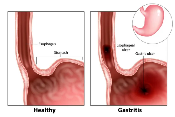 Gastritis Úlcera Esofágica Úlcera Gástrica Ilustración Del Estómago — Vector de stock