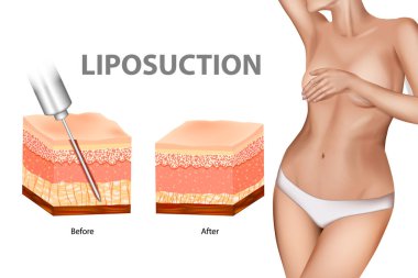 Liposuction veya lipo. İnsan derisi katman lipo öncesi ve sonrası Liposuction. Plastik cerrahi Infographic estetik yordamlar