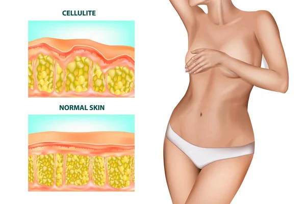 Huden Tvärsnitt Celluliter Bildas Banderoll Med Realistiska Vackra Kvinnorna Utan — Stock vektor
