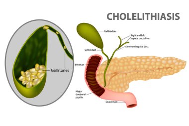 Gallstone (Cholelithiasis) is a chronic recurrent hepatobiliary disease.  clipart