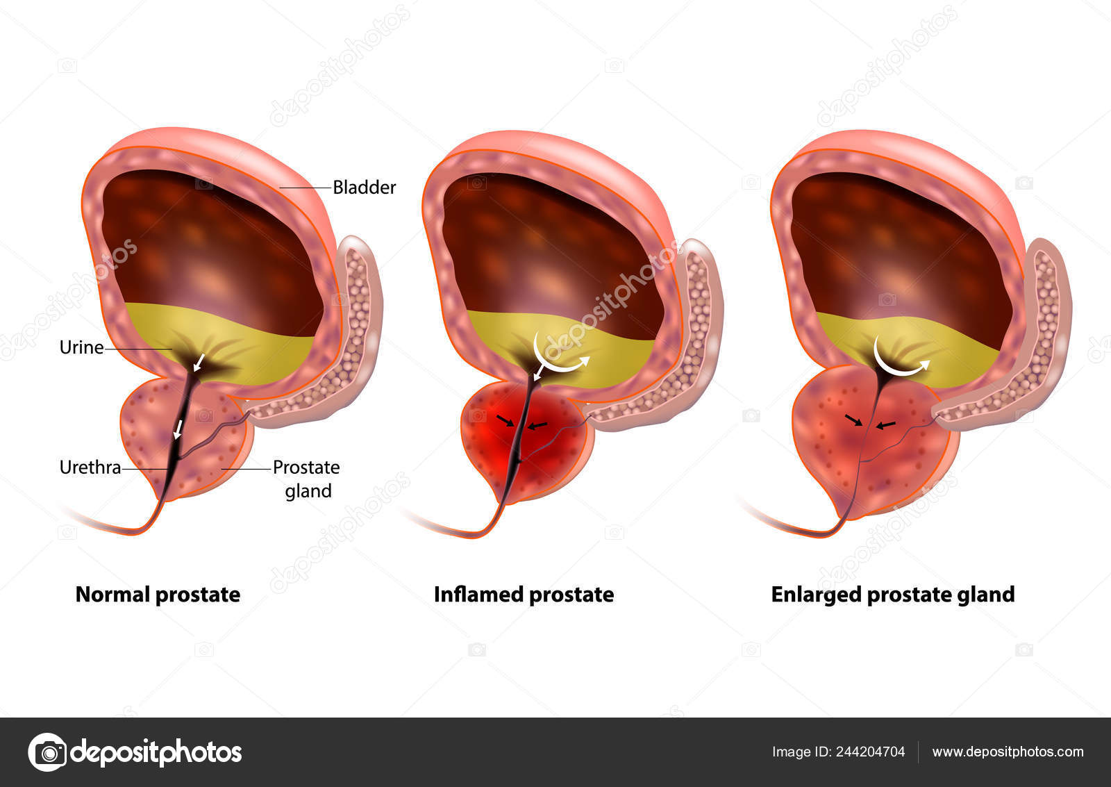 43 éven belül prostatitis Mi a krónikus számú prostatitis dgpzh