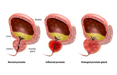 Benign Prostat Hiperplazisi (Bph). Prostat ve genişlemiş prostat bezi iltihaplı