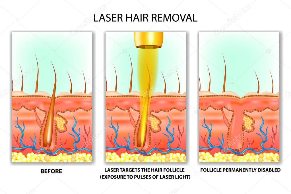 Laser hair removal. Exposure to pulses of laser light
