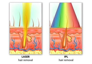 IPL (Yoğun Atımlı Işık) ve lazer epilasyon. Saç kaldırma farklılıklar