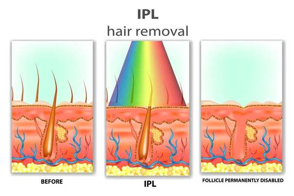 IPL (Yoğun Atımlı Işık). IPL epilasyon nasıl çalışır