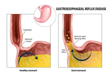 Gastroesophageal reflux disease (Gerd or Heartburn).  Acid reflux clipart