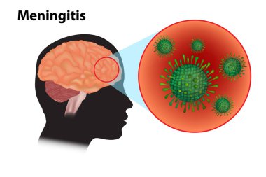 Meningitis - inflammation of the brain. Viral meningitis and encephalitis clipart