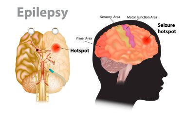 Seizures epilepsy - Seizure hotspot. Medical illustration of a brain with epilepsy clipart