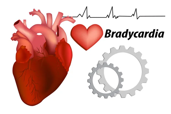 Bradykardia Bradykardia Zatokowa Zespół Chorych Zatok — Wektor stockowy