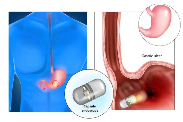 Endoscopie Gélule Alias Cam Pilule Diagnostic Médical — Image vectorielle