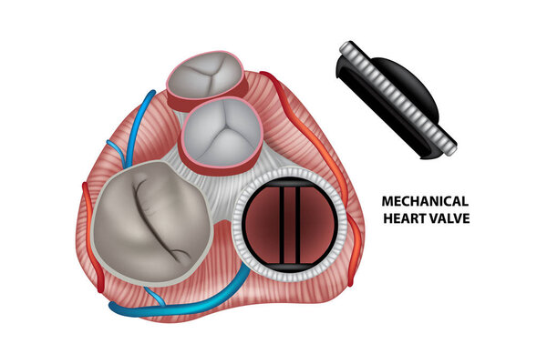Circular mechanical (artificial) valve inside heart.