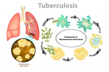 Tüberküloz (TB). Pulmoner tüberküloz ilerlemesi-Mycobacterium tüberküloz (MTB) bakteriler