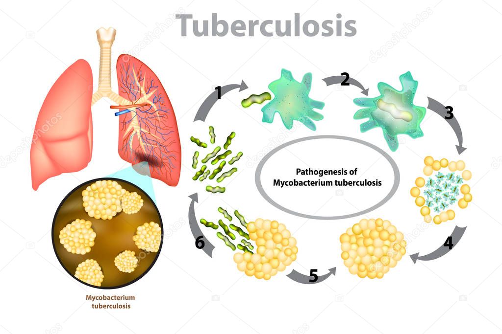 Tuberculosis (TB). Progression of pulmonary tuberculosis - Mycobacterium tuberculosis (MTB) bacteria
