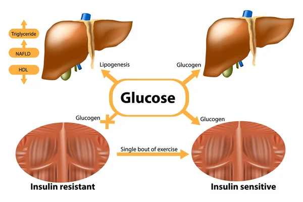 Glicogeno Nel Fegato Nei Muscoli Insulina Sensibile Resistente All Insulina — Vettoriale Stock