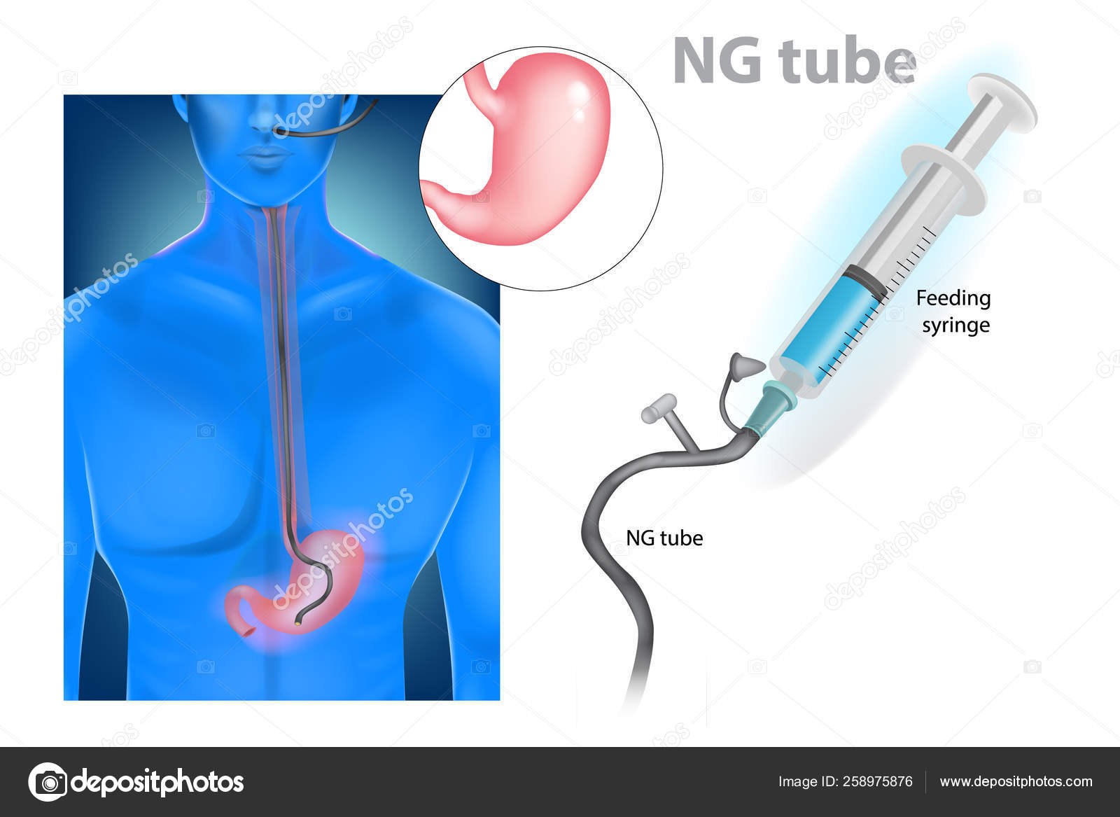 Intubación Nasogástrica Tubo Nasogástrico Tubo Stock Vector by ©Sakurra 258975876