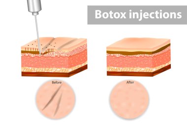 Kırışıklıklar için Botox enjeksiyonları Tıbbi illüstrasyon. Botox enjeksiyonu ile cilt katmanları