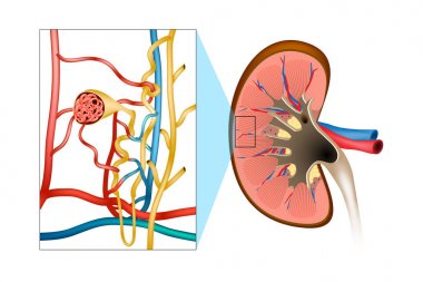 Glomerulonephritis (GN). Inflammation either of the glomeruli or of the small blood vessels in the kidneys. clipart
