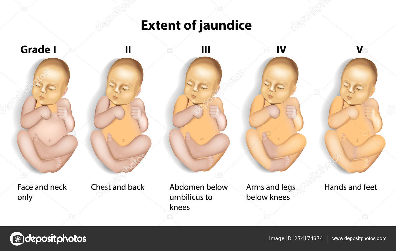 Con Ictericia Bilirrubina Alta Bebes Consecuencias Piel Amarilla