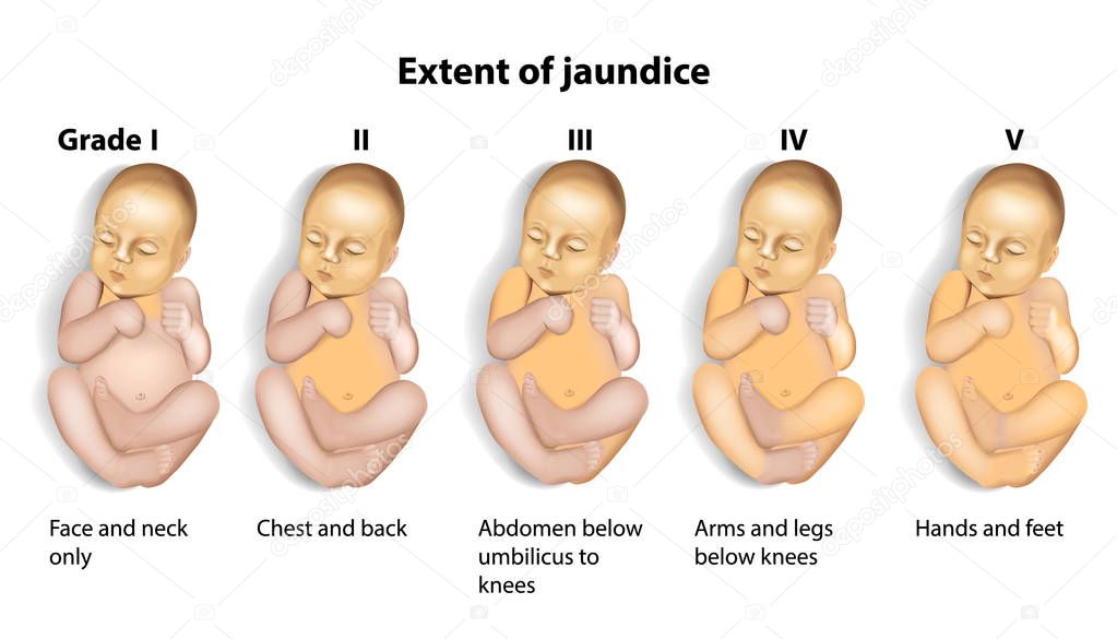 Extent of Jaundice (icterus) with Baby