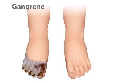 Kangren, ölümün neden olduğu bir doku türüdür. Ayak ayak iznini ve ülserasyonlarını gösteren diyabetik arter hastalığı.