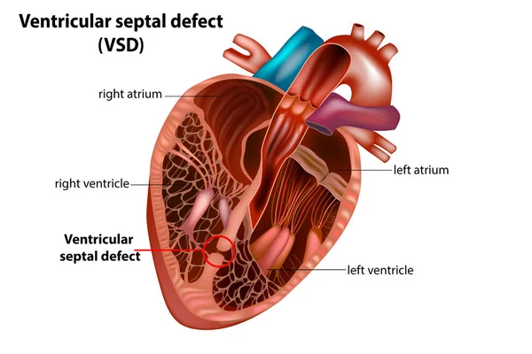 Ventriküler septal defekt (Vsd). Konjenital kalp defekti