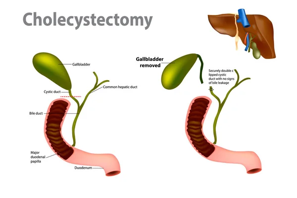 Epehólyag Eltávolító Sebészet Laparoszkópos Cholecystectomia — Stock Vector