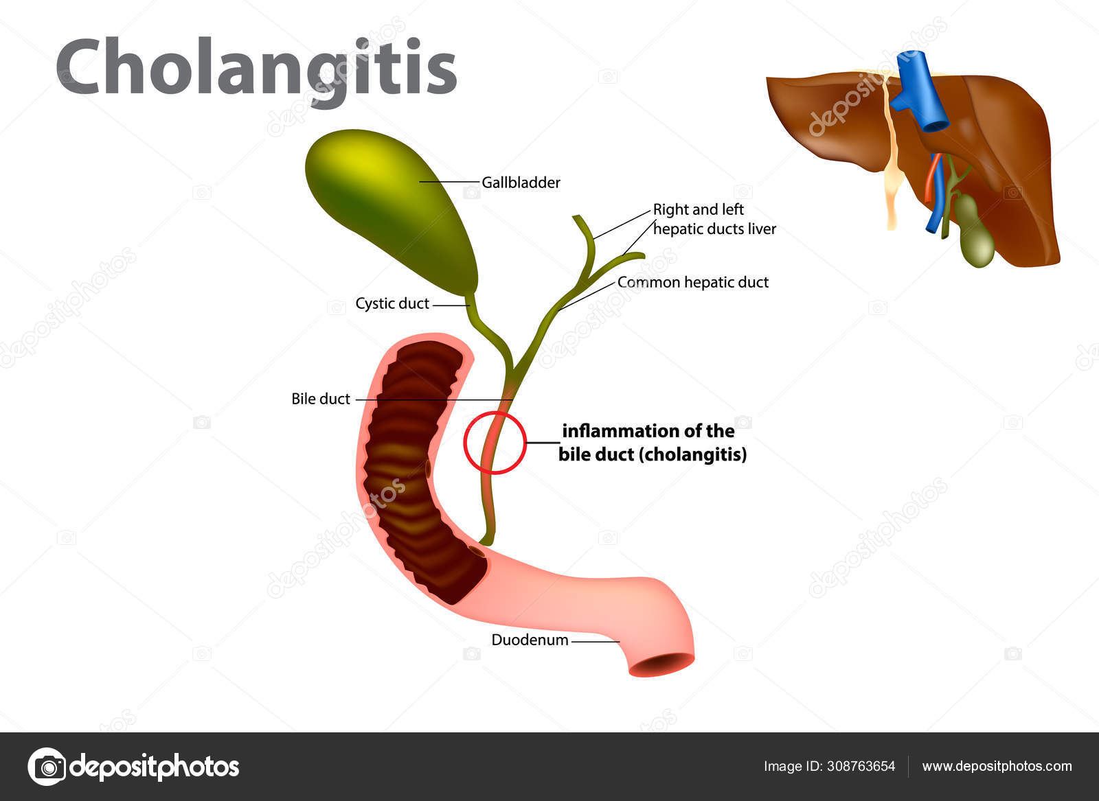 Entzündung Des Gallengangs Aufsteigende Cholangitis Oder Akute