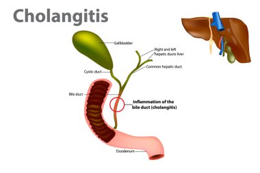 Inflammation of the bile duct (Ascending cholangitis or acute cholangitis) clipart
