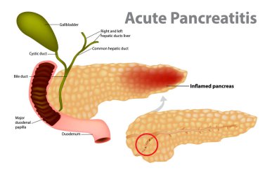 Acute Pancreatitis caused by gallstone. Gallstones block the flow of pancreatic juices into the duodenum. clipart