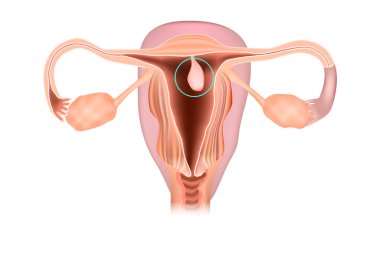 Endometriyal polip ya da rahim polipsi. Rahim resmi, kadın üreme sistemi hastalıkları.