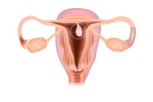 Endometrial polyp or uterine polyp. Illustration of the uterus, female reproductive system diseases
