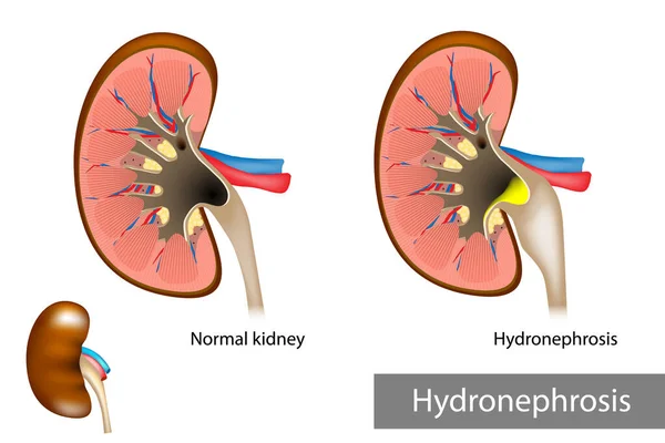 Hydronéphrose. Dilatation des voies urinaires — Image vectorielle