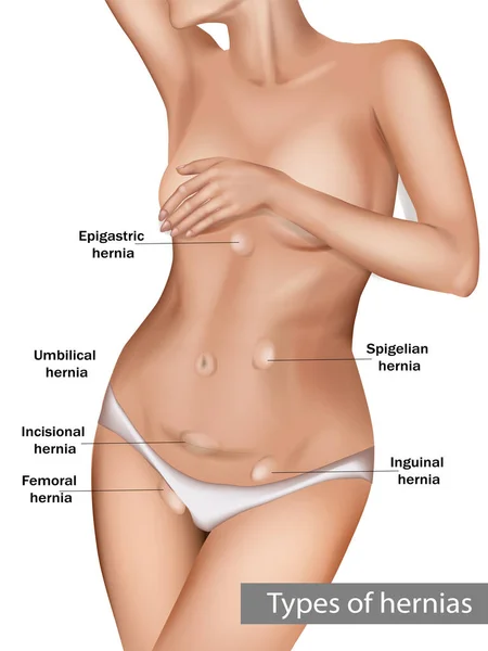 Tipos de hernias abdominales — Vector de stock