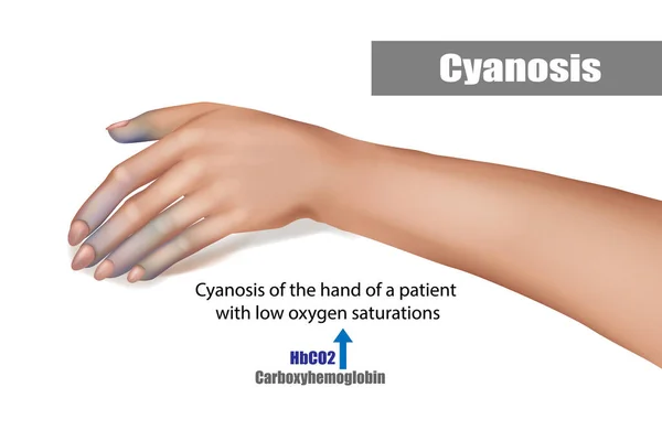 Cianose da mão de um paciente com baixa saturação de oxigênio —  Vetores de Stock