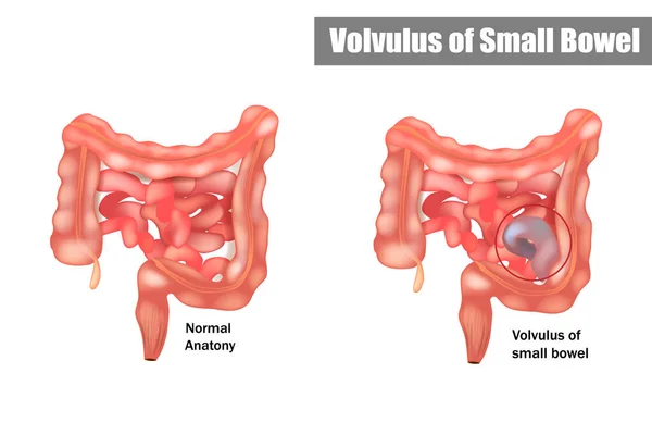 Volvulus van dunne darm. Vectorillustratie — Stockvector