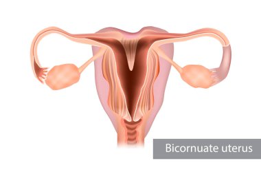 A bicornuate uterus or bicornate uterus is a type of mullerian anomaly in the human uterus. Illustration, female reproductive organ clipart