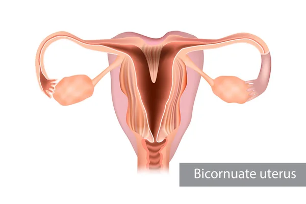 Bicornuate Uterus Bicornate Uterus Type Mullerian Anomaly Human Uterus Illustration — Stock Vector