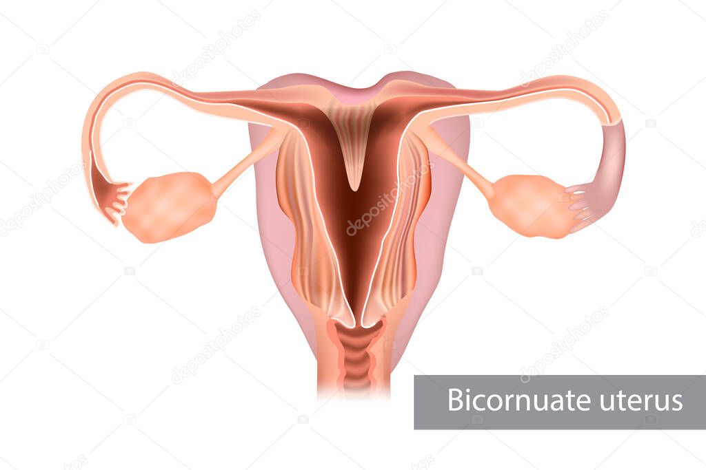 A bicornuate uterus or bicornate uterus is a type of mullerian anomaly in the human uterus. Illustration, female reproductive organ