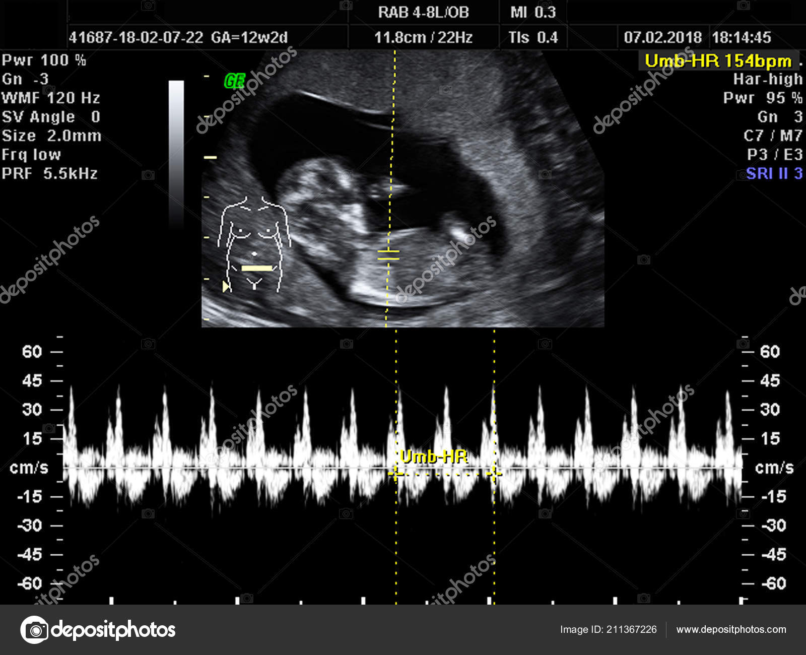 Embarazo 12 semanas 4 dias