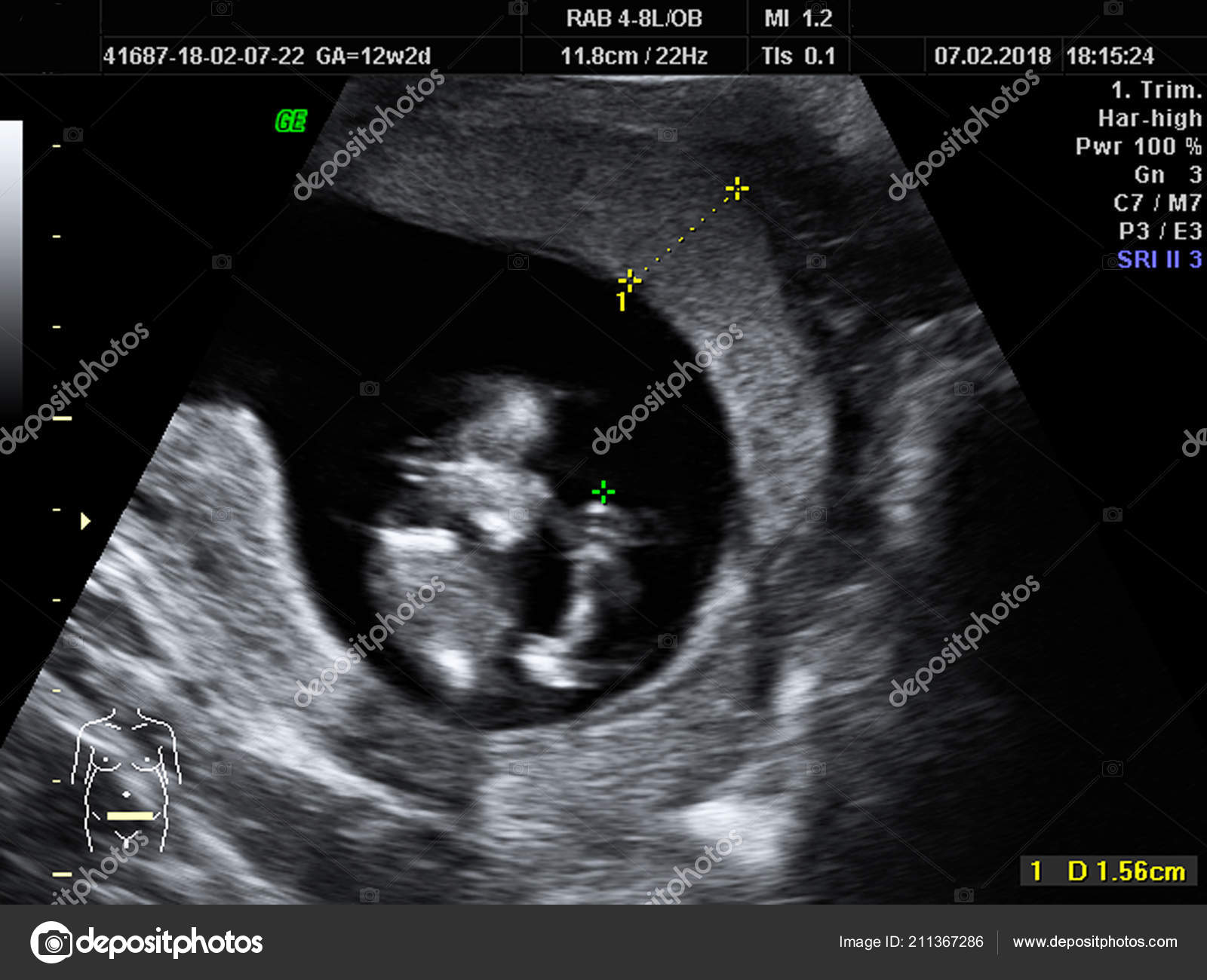 Embarazo 12 semanas 4 dias