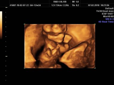 gerçek hamile kadın süresi 12 hafta 2 gün 3d ultrason tanısında