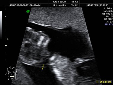 bir hamile kadın süresi 12 hafta 2 gün çocuğun gerçek ultrason tanı