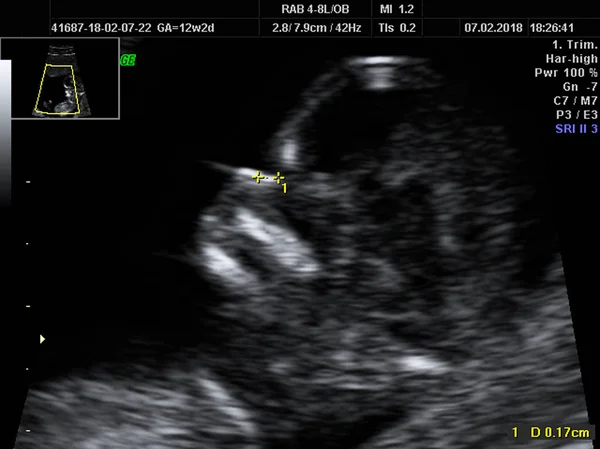real ultrasound diagnosis of a pregnant woman, duration: 12 weeks 2 days, nose bone size