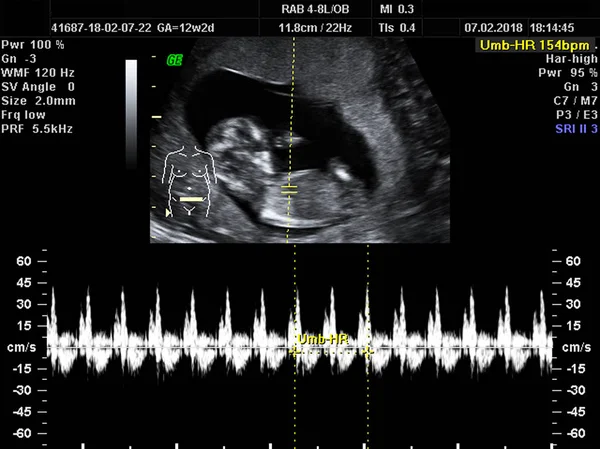 real ultrasound diagnosis of a pregnant woman, duration: 12 weeks 2 days,  heart heartbeat of a child