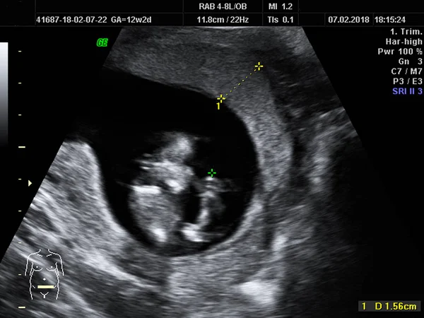 real ultrasound diagnosis of a pregnant woman, duration: 12 weeks 2 days, uterine wall thickness