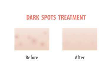 Dark spots treatment comparison illustration vector on white background. Skin concept. clipart