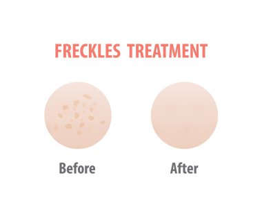 Freckles treatment comparison illustration vector on white background. Skin concept. clipart